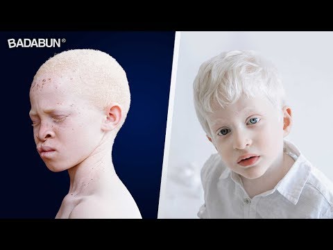 Por qué a los albinos se les mueven los ojos?