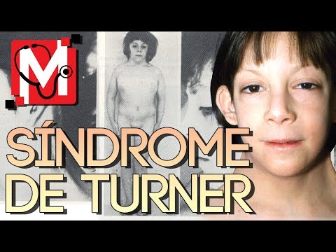 Consecuencias del síndrome de Turner: impacto en la salud.